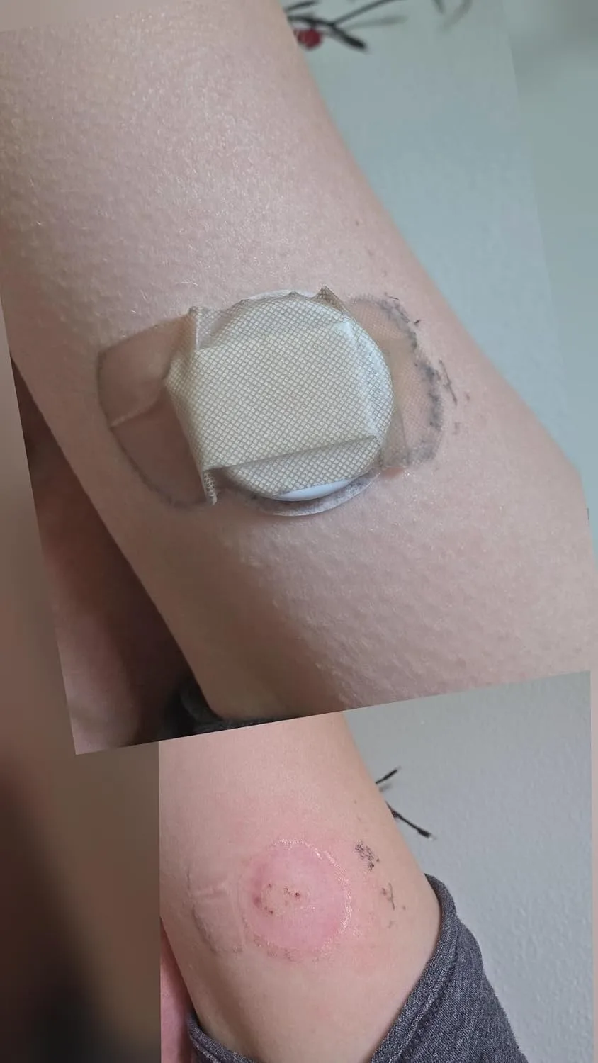 Customer photo showing continuous glucose monitor sensor applied to arm